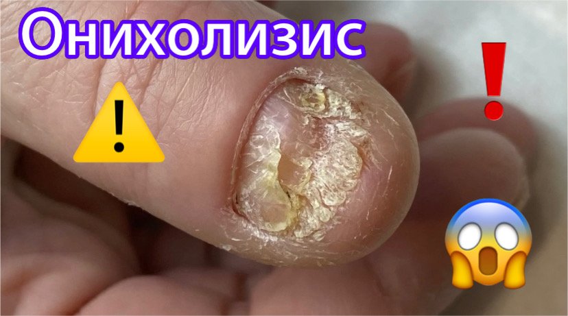 Зачистка онихолизиса ⚠️❗️??