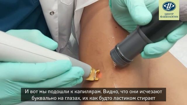 Удаление сосудистых звездочек на ногах ультрасовременным лазером Cutera Xeo смотреть онлайн