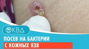 ? Посев на бактерии с кожных язв. Клинический случай №686