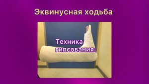 Эквинусная ходьба