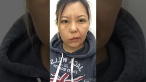 Парез лицевого нерва в результате удаления невриномы