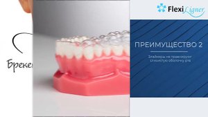 Flexi Ligner - исправление прикуса элайнерами