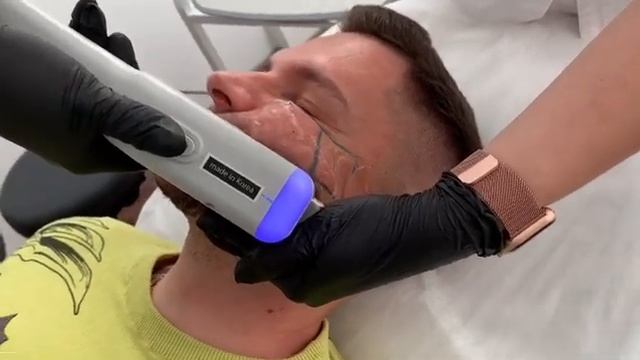 SMAS-лифтинг смотреть онлайн