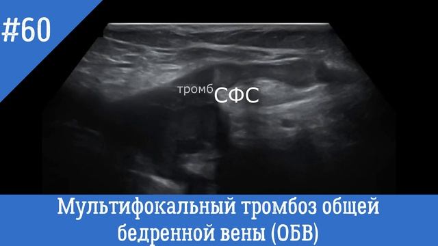 УЗИ сосудов. Мультифокальный тромбоз общей бедренной вены (ОБВ)
