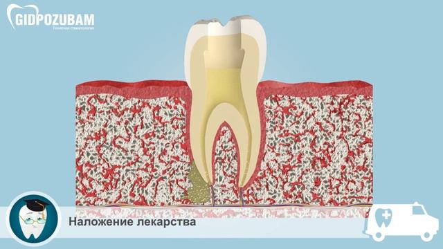 Гранулема зуба: развитие, этапы лечения гранулемы смотреть онлайн