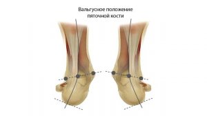 Плоскостопие. Почему появляется и что делать? / Александр Колдаев