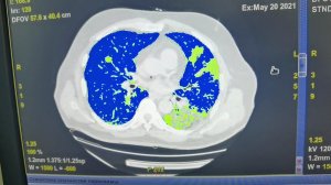 КТ легких в станице Ленинградской. Диагностика вирусной пневмонии
