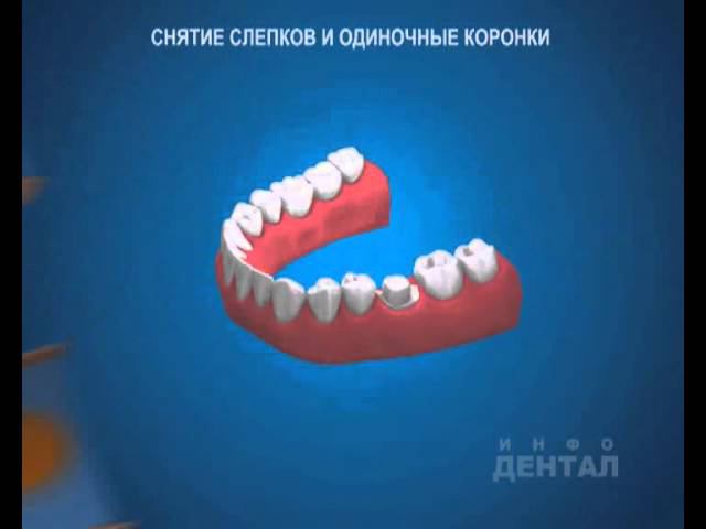 Слепки и одиночные коронки