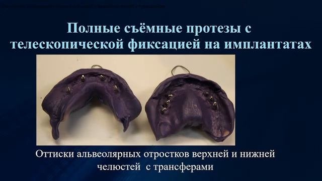 13.04.2022 - Лекция по сложному протезированию