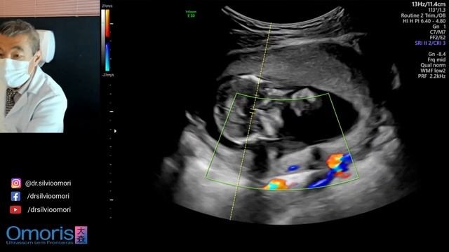 ULTRASSOM OBSTÉTRICO. Imagens em 3D. Gestação 14 semanas. смотреть онлайн