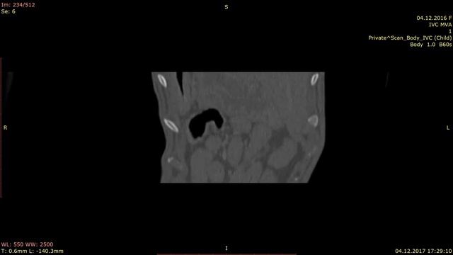 Остеома ребра компьютерная томография смотреть онлайн