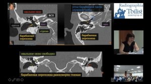 СКТ височной кости. Часть 1