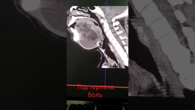 Год терпела боль в шее! Киста под языком! Срединная киста шеи