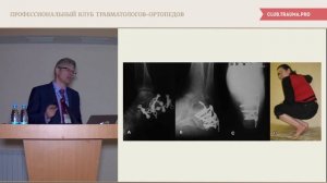 Травмы стопы при сочетанных и множественных повреждениях