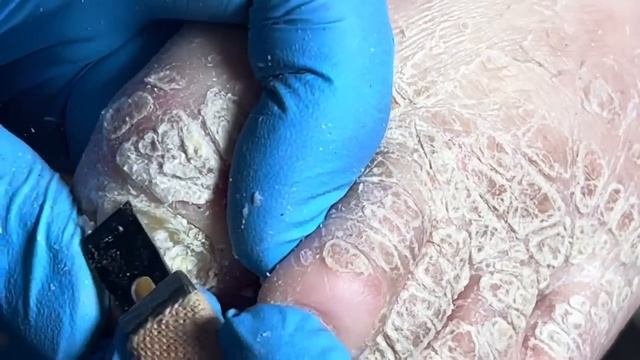 Super long thick nails! Infected and haven't cut it for five months【Pedicure Master Lin Jun】