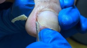 A very deep ingrown toenail, it hurts just looking at it【Xue Yidao】