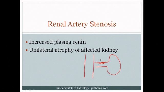 Pathoma USMLE - VII ГЛАВА - 2.Гипертония