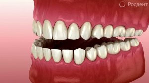 Нарушение прикуса - мезиальный прикус