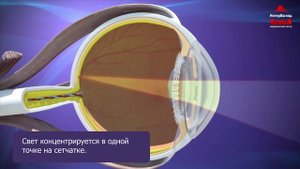 Астигматизм: что это, почему возникает, как лечить?