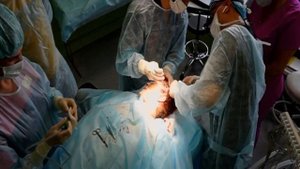 Тотальный фейслифтинг (Круговая подтяжка лица)