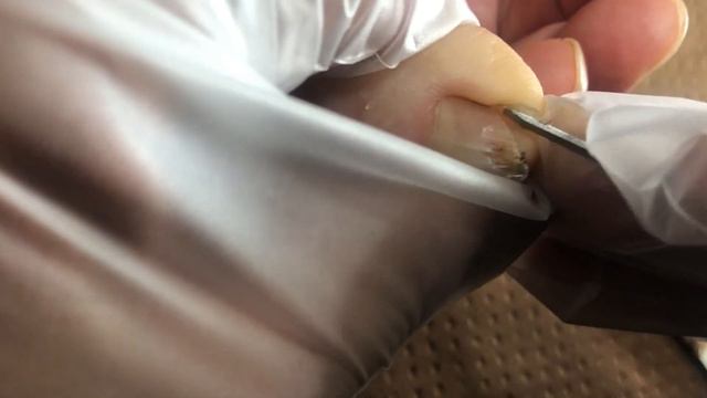 Y-shaped nails with paronychia, can't do anything【Foot Scalpel】 смотреть онлайн