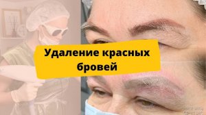 Что делать с КРАСНЫМИ БРОВЯМИ? Лазерное удаление перманентного макияжа бровей красного цвета.