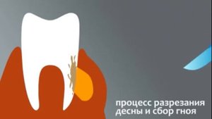 Флюс  Лечение флюса