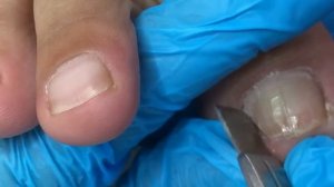 Provide patients with perfect ingrown toenail trimming【Crazy pedicure room】