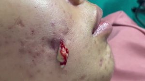 Удаление черных точек 2021 - Remoção de cravo 2021 - Pimple Popping 2021 Blackhead Removal EP002