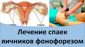 Лечение спаек яичников фонофорезом