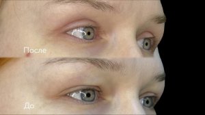 До и после верхней блефаропластики