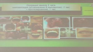 Георгий Патарая. Лекция о современных методах имплантации.