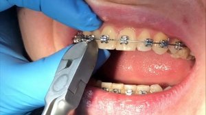 Снятие брекетов | брекеты Самара влог | braces off