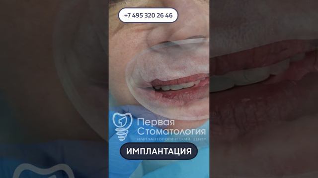 Эффект ДО и ПОСЛЕ. Имплантация зубов пациенту.