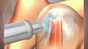 3D визуализация лечения пяточной шпоры методом УВТ