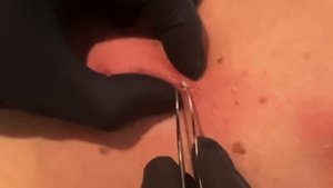 DILATED PORES OF WINER!