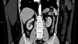 КТ органов брюшной полости с контрастированием
