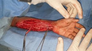 Mastering Volkman's Ischaemic Contracture Surgery |  Enhanced Hand Vitality! Part 3