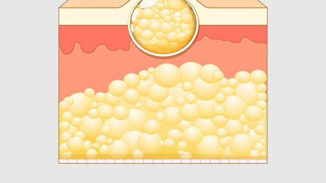 Хирург проболтался! Жировик (липома) исчезнет уже через день! смотреть онлайн