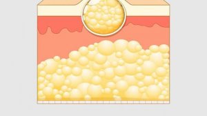 Хирург проболтался! Жировик (липома) исчезнет уже через день!