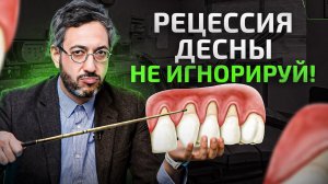 Уменьшилась десна и оголяются корни зубов. Рецессия десны (Не игнорируй это)