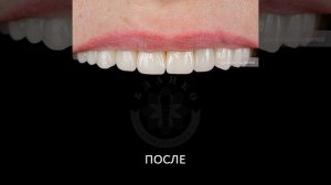?? Замена старых коронок на коронки из оксида циркония ⭐️