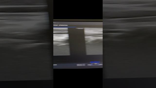 Искривление позвоночника на узи. Узи сосудов шеи и головы. УЗДС БЦА. Сосудистый хирург. Флеболог смотреть онлайн