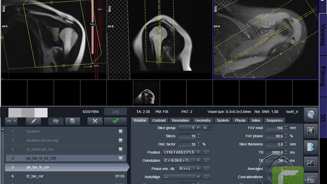 MRI SHOULDER فحص الرنين المغناطيسي على الكتف смотреть онлайн