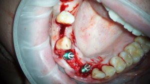 Одномоментная имплантация передних зубов с костной пластикой