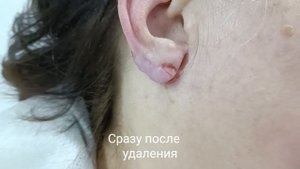 Удаление келоидного рубца.