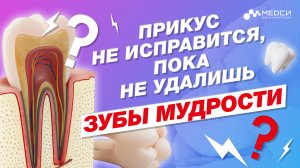 Зачем удаляют зубы мудрости при исправлении прикуса?