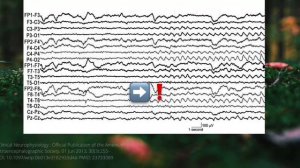 Доброкачественные эпилептиформные паттерны. SREDA.