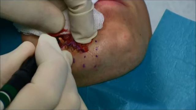 Dr Vandeputte Пластика рубца смотреть онлайн