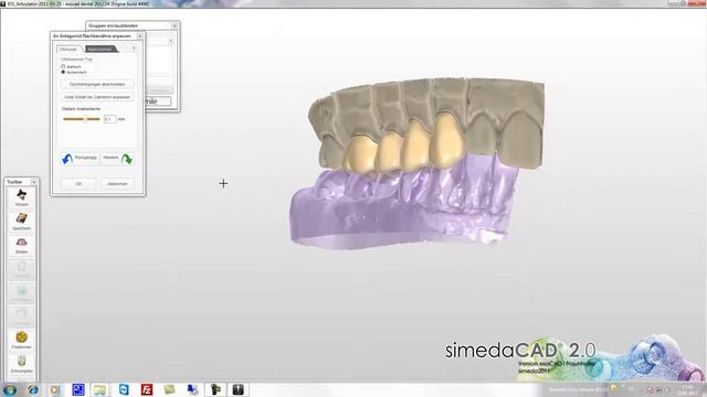 simedaCAD (exoCAD) Articulator